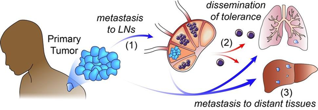 <em>A diagram from the National Cancer Institute depicting how cancer from a tumor can spread into distant tissues. Using Bhargava&rsquo;s digital pathology technology, surgeons would be able to identify this metastasis as it occurs in step (1), removing lymph nodes (LNs) that are likely cancerous.</em>