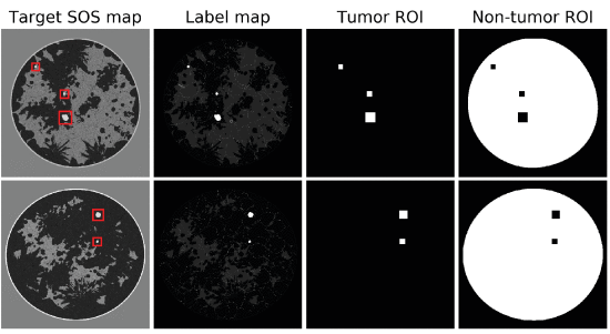 Illustrative examples of tumor and non-tumor regions within breast images. From left to right: target SOS maps displaying tumor ROIs (red boxes), label maps highlighting tumor locations, binary maps of tumor ROIs, and binary maps of normal breast tissue excluding the tumor ROIs. Both tumor and normal tissue regions were employed for the calculation of traditional IQ metrics, as well as for determining distinct weight values for each region when fine-tuning the networks using the WMSE loss. (Image from &amp;amp;amp;amp;amp;lt;a href=&amp;amp;amp;amp;amp;quot;https://ieeexplore.ieee.org/document/10679176&amp;amp;amp;amp;amp;quot;&amp;amp;amp;amp;amp;gt;https://ieeexplore.ieee.org/document/10679176)&amp;amp;amp;amp;amp;lt;/a&amp;amp;amp;amp;amp;gt;