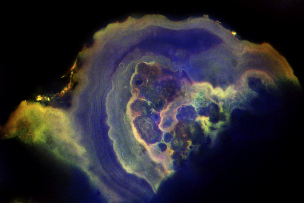 With the first detailed look inside breast tissue calcifications, bioengineering researchers at Illinois- including professors Rohit Bhargava and Ashok Samuel- documented distinct differences between benign and cancerous deposits. In this sample of ductal carcinoma in situ, a precursor to invasive breast cancer, calcium phosphate nodules clumped together and were encrusted by thick layers of more calcium phosphate. Image by Mayandi Sivaguru