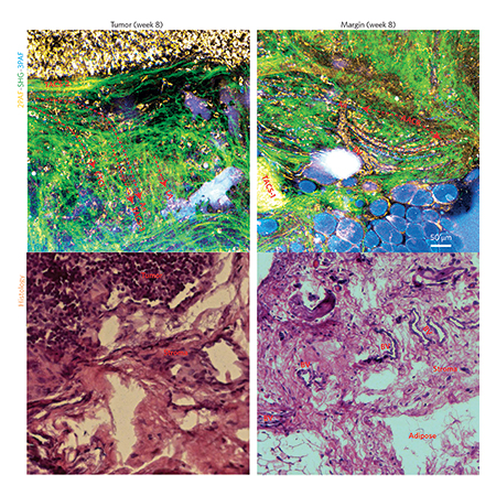 Label-free multimodal optical imaging of local tumor invasion along a tumor margin. Label-free images from fresh mammary tissue (top row) are compared to standard stained histology images (bottom row). A wealth of structural, molecular, metabolic and functional information can be visualized rapidly in real time without the use of stains or labels, helping to elucidate the mechanisms in carcinogenesis and offering the potential for new diagnostic and prognostic biomarkers of cancer.