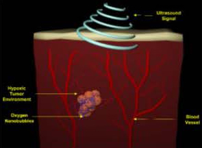 In this representation, the nanobubbles (blue dots) serve as ultrasound contrast agents and could be triggered by ultrasound to release oxygen and destabilize the hypoxia-adaptive pathways in the tumor.