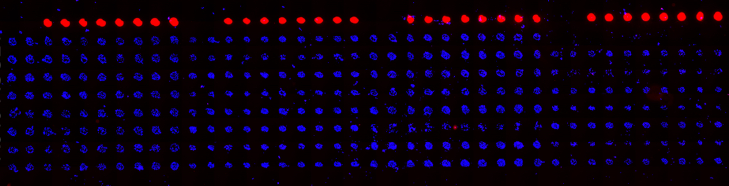 A cell microarray culture platform containing lung adenocarcinoma cells. 