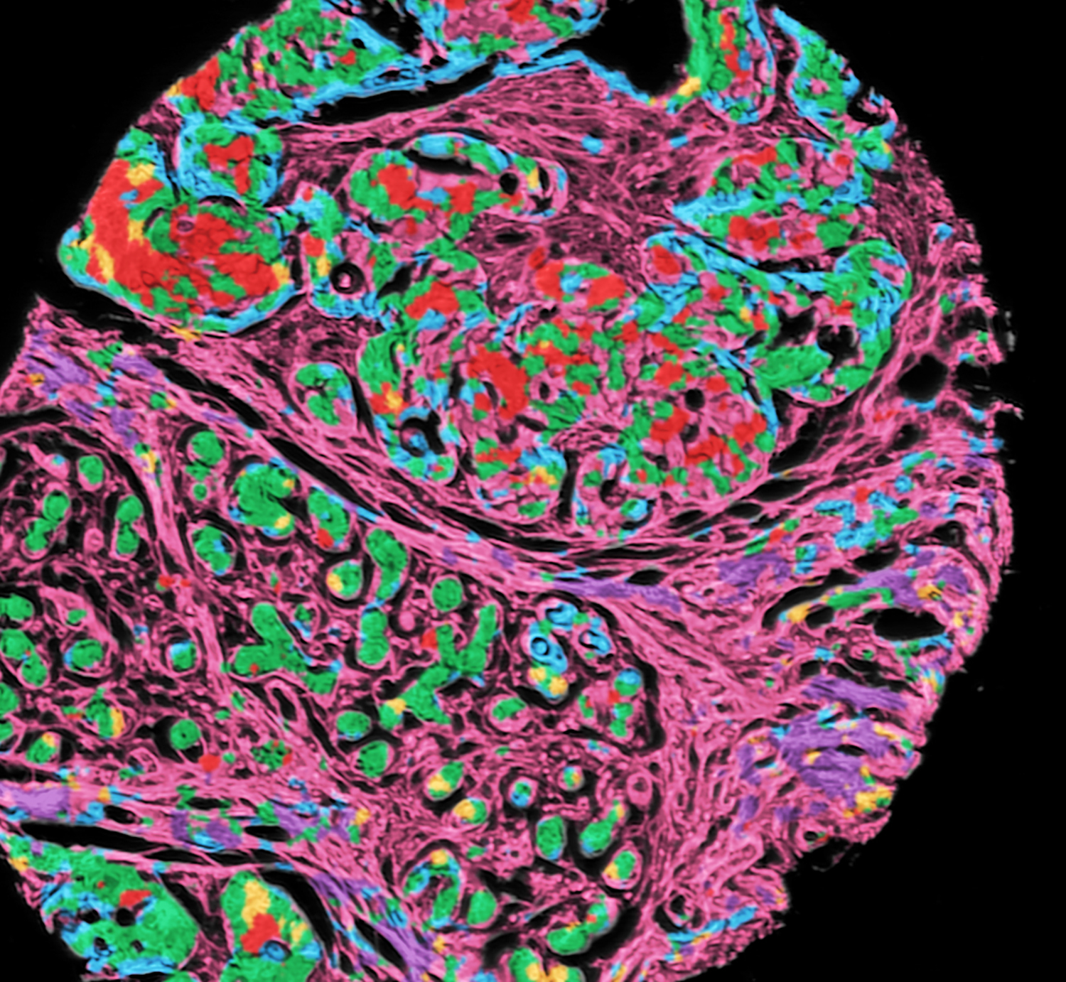 Digital detection of tumor and its microenvironment on breast biopsies using chemical imaging. 