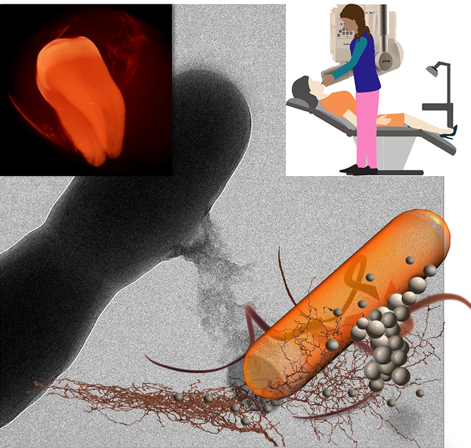 In this illustration, nanoparticles attach to or are taken up by the bacteria cells. Pan and his students are the first group to demonstrate that early detection of dental plaque in the clinic is possible using the regular intraoral X-ray machine which can seek out harmful bacteria populations.