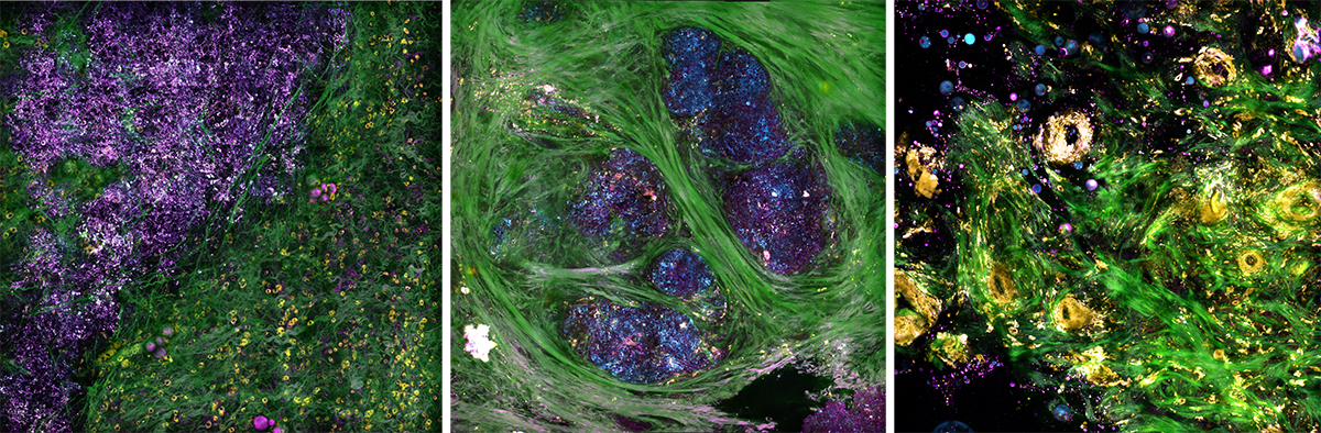 Label-free intraoperative nonlinear imaging of the tumor microenvironment provides real-time visualization of structural and molecular features, including extracellular vesicles that can be potential biomarkers of cancer aggressiveness. 

Credit:  Biophotonics Imaging Laboratory, Beckman Institute for Advanced Science and Technology, University of Illinois at Urbana-Champaign.
