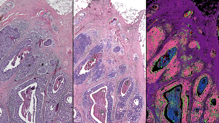 This side-by-side comparison of a breast tissue biopsy demonstrates some of the infrared-optical hybrid microscope's capabilities. On the left is a tissue sample dyed by traditional methods. Center image is a computed stain created from infrared-optical hybrid imaging. On the right, tissue types are identified with infrared data, and the pink in this image signifies malignant cancer.

Images courtesy of Rohit Bhargava.