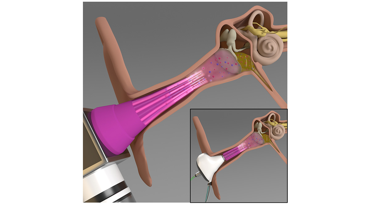 An illustration of the cold plasma-integrated otoscope (main figure) and the earbud (inset) for the potential treatment of middle ear infections.&nbsp;