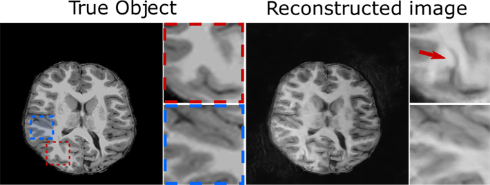 A schematic of hallucinations from DL-based reconstruction of a clinical pediatric MR brain image 
