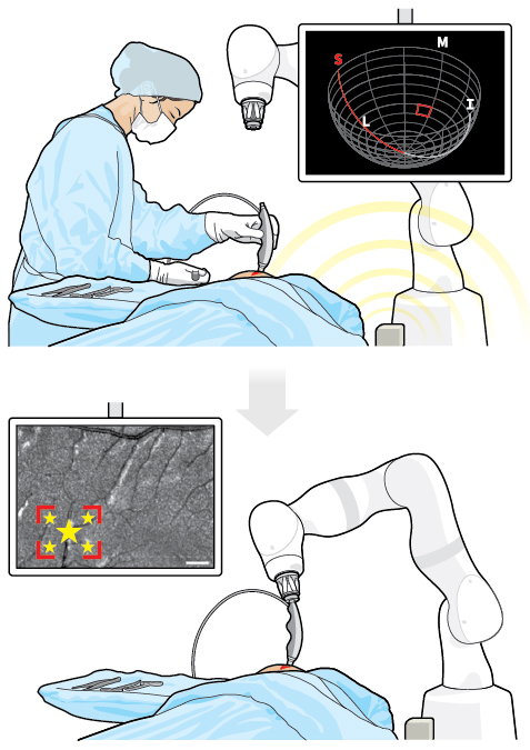 The MarginDx system in action: Post-excision, a surgeon uses a handheld probe to scan the tumor cavity and position the probe via an integrated EM tracking system. (top) The probe, once mounted to the robotic arm, returns to the tumor cavity to re-image and classify tissue using AI technology. (bottom)